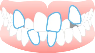 ガタガタした歯並びや<br>八重歯(叢生)