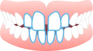 すきっ歯<br>(空隙歯列弓)